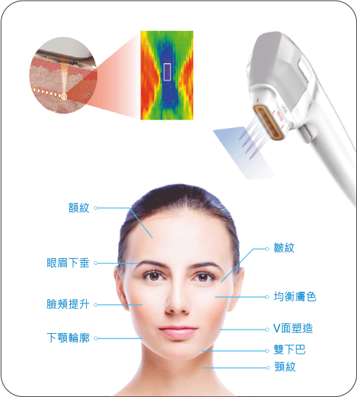 classys-Ulfit-HIFU-龍捲風溶脂波-picA2